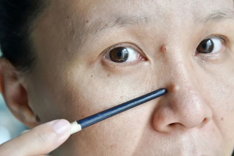 The Meaning Of Moles On Your Nose