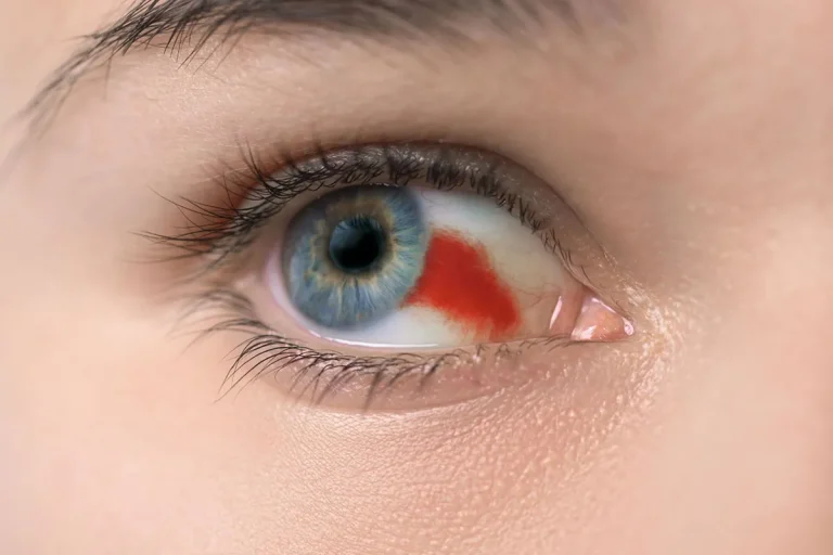 The Spiritual Meaning Of Broken Blood Vessels In The Eye